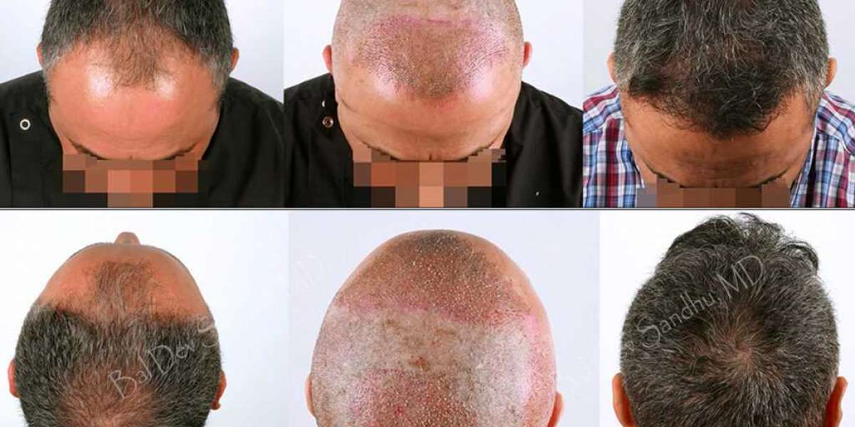 Find The Best Hair Transplant Doctor in New Jersey Online