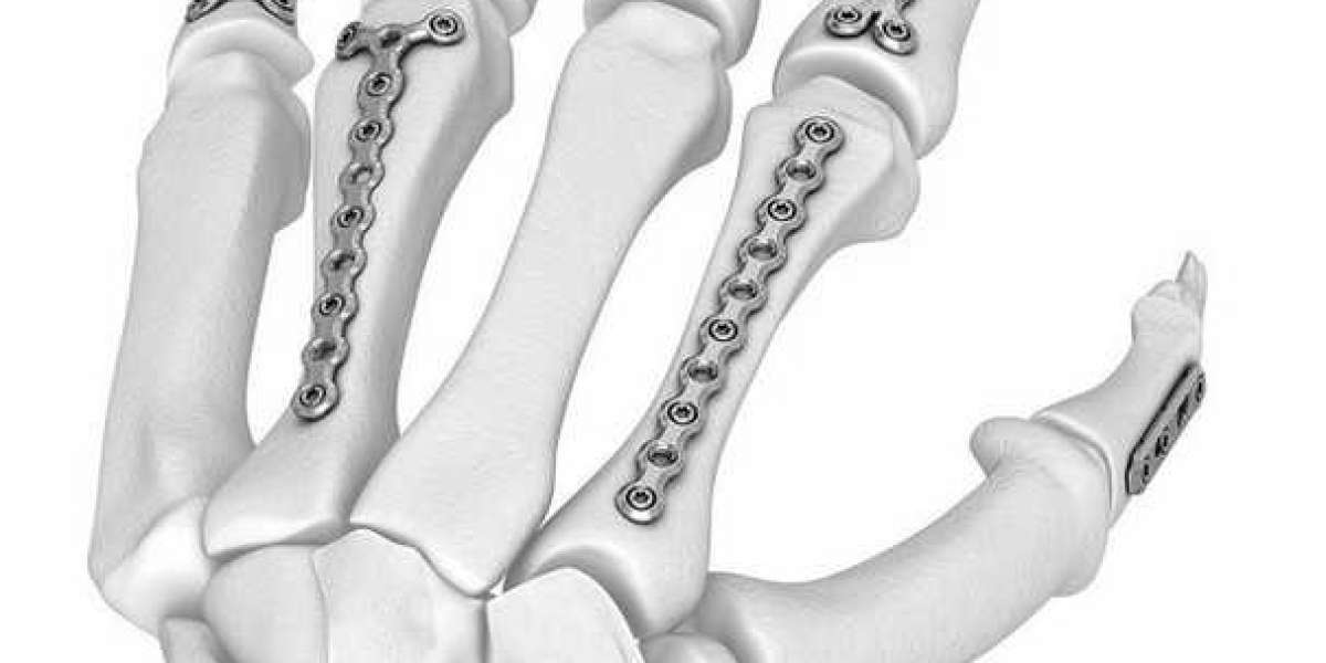 Top Orthopedic Implant Companies