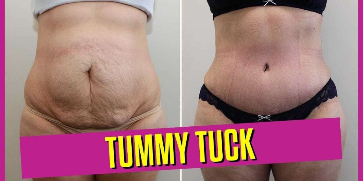 A tummy tuck can help you achieve a flatter stomach