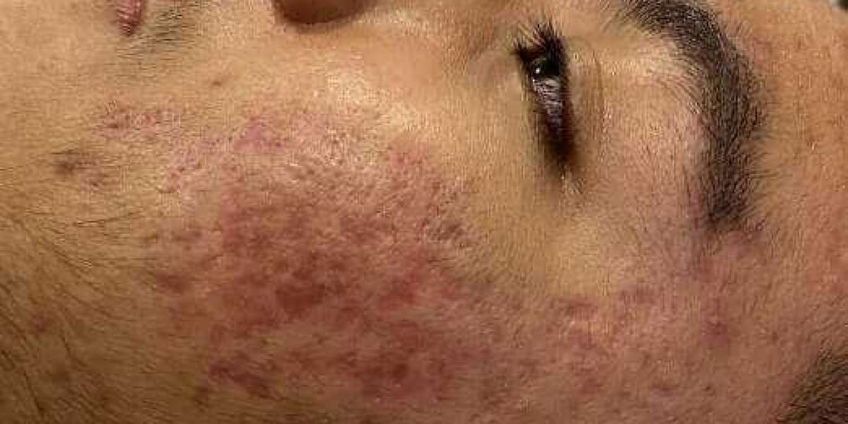 Consult Now for the Best Acne Scar Treatment in Bangalore