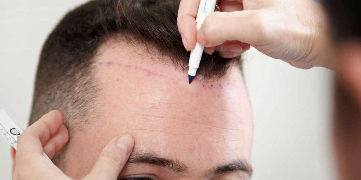 Hairline Lowering Transplant | Hairline Lowering Transplant Cost