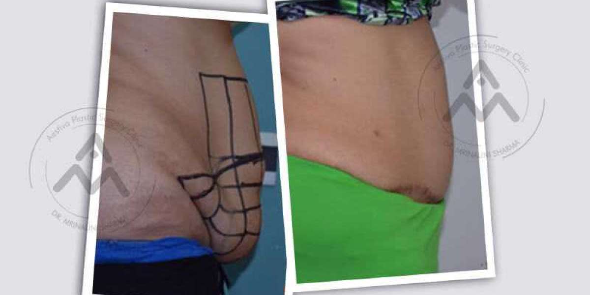 Detailed Guide On Types of Tummy Tuck