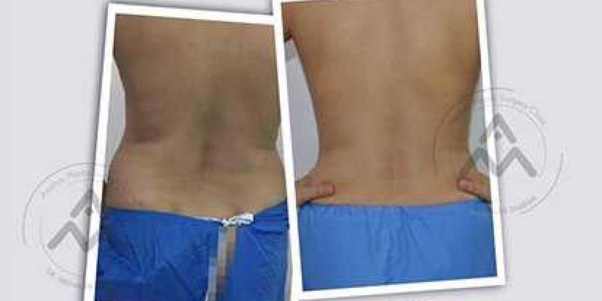 Liposuction Treatment For A Contoured Look