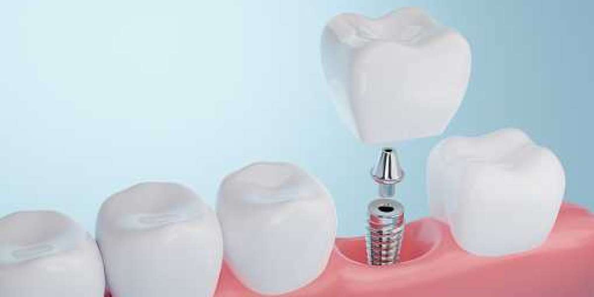 Dental Implants Near Me - Valley Creek Dental Care