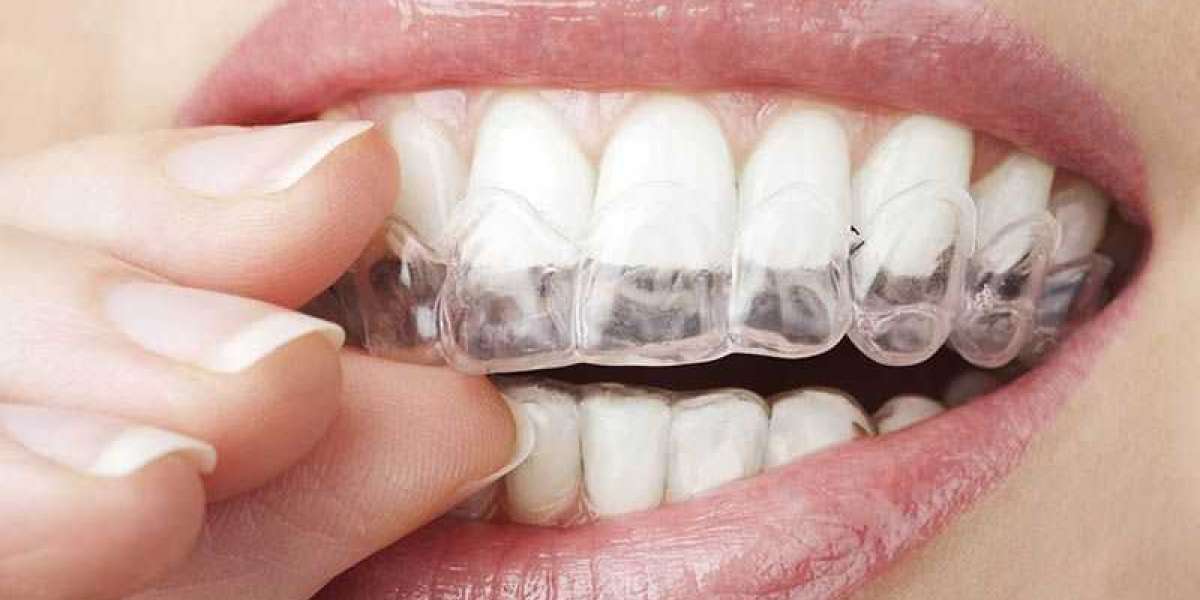 Is It Better to Vape With Invisalign?