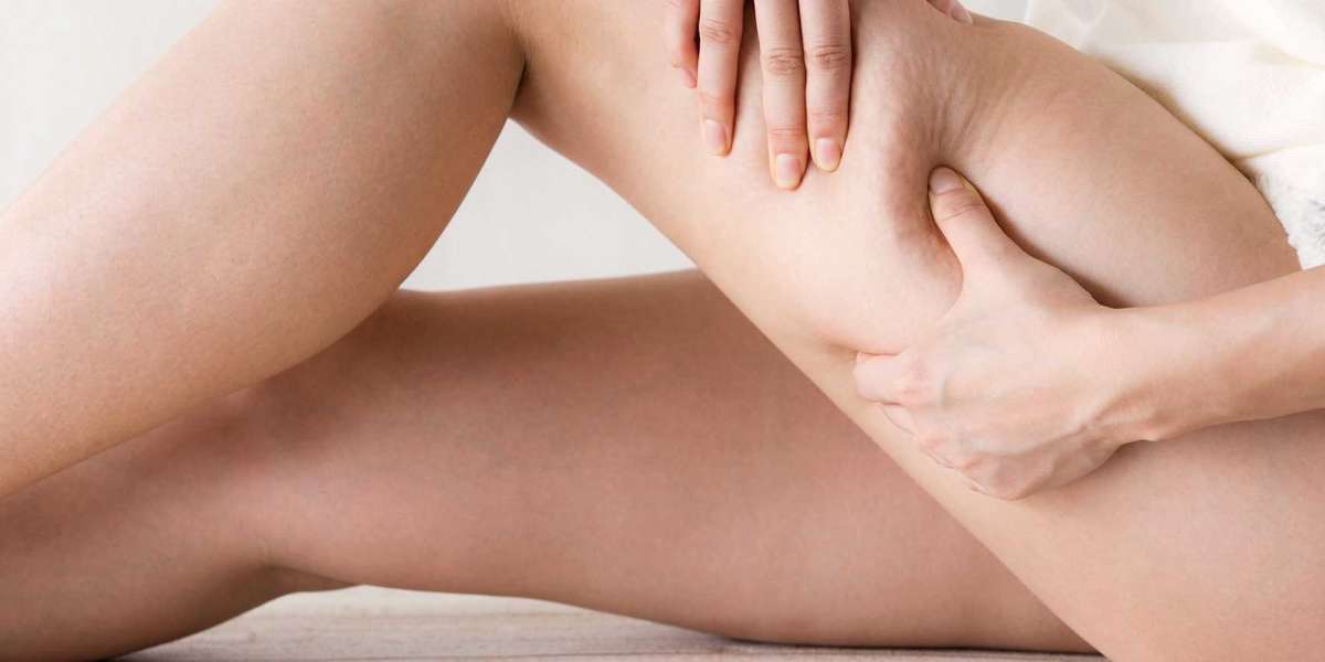 Which Cellulite Treatment Is Most Effective