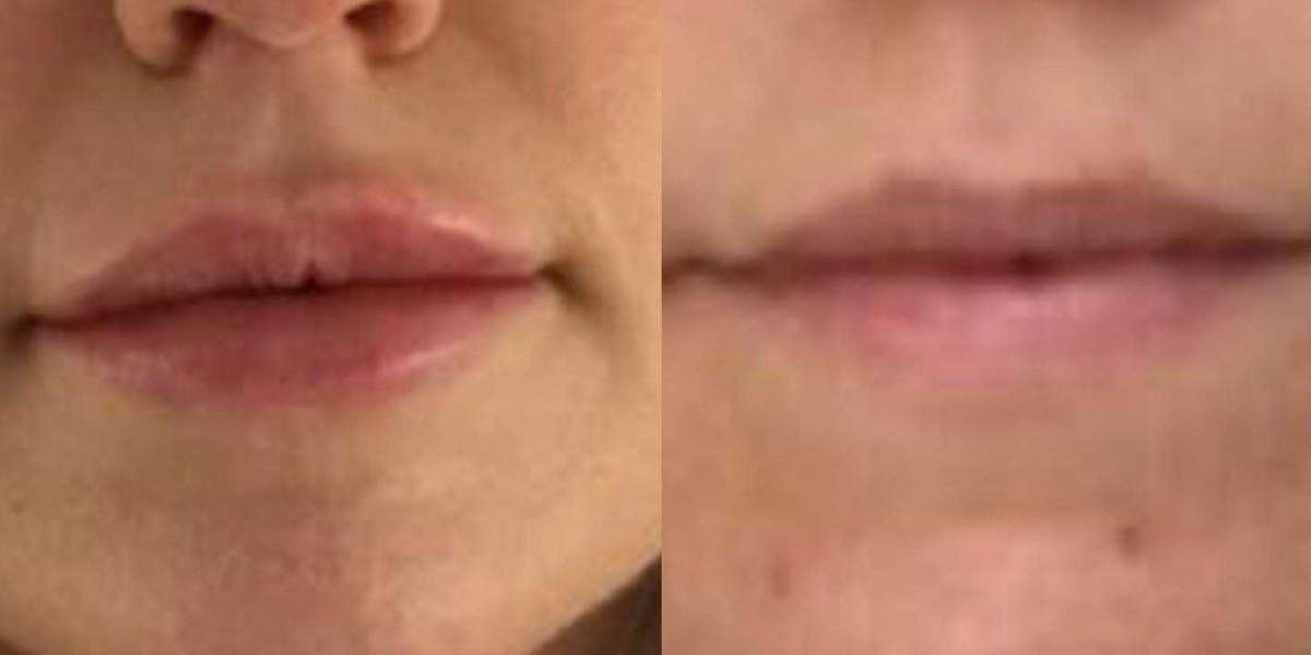 Recover your Full Lips by opting for Lip Augmentation London Using Dermal Fillers