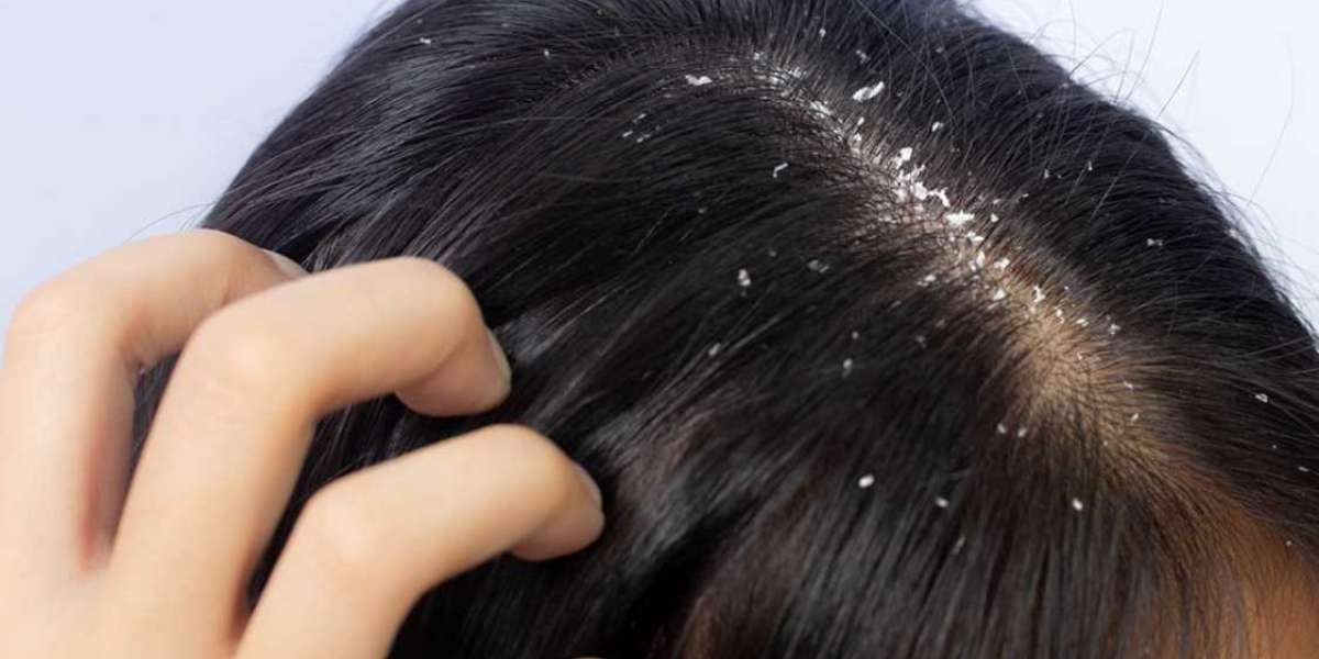 Skin Medicines for Dandruff: Express Farewell to Drops