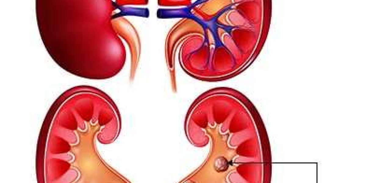 3 Ways To Know If You Have Kidney Stones