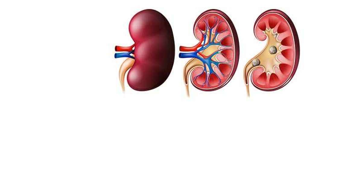 Evaluating the Various Kidney Stone Treatments | Dr. Niren Rao