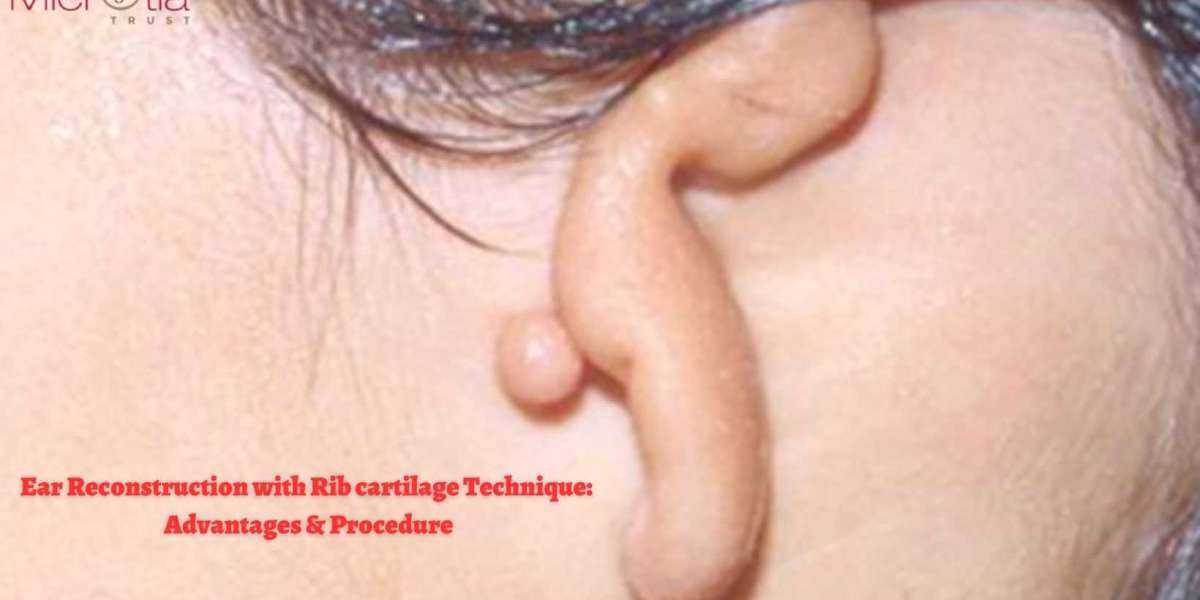 Ear Reconstruction with Rib cartilage Technique: Advantages & Procedure
