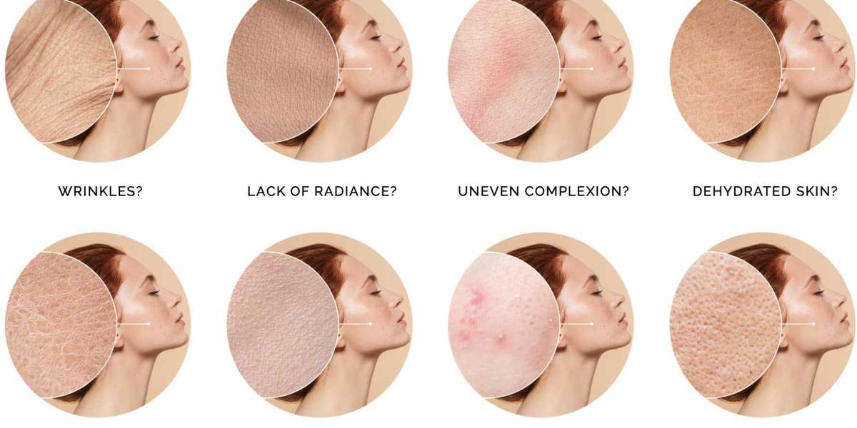(Special Offer) Amarose Skin Tags Remover Is Safe Or Effective?