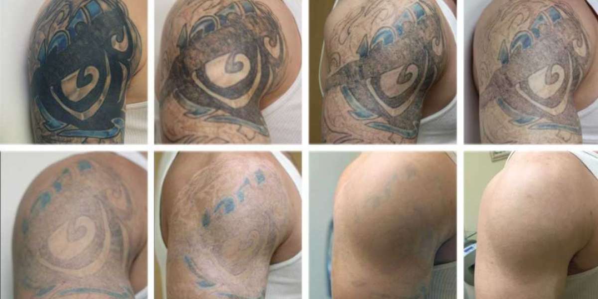 Everything You Need To Know About Laser Tattoo Removal Safety