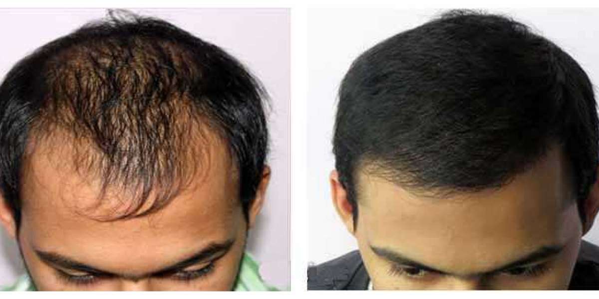 Best Hair Transplant Surgeon in Delhi - Dr Vivek Kumar