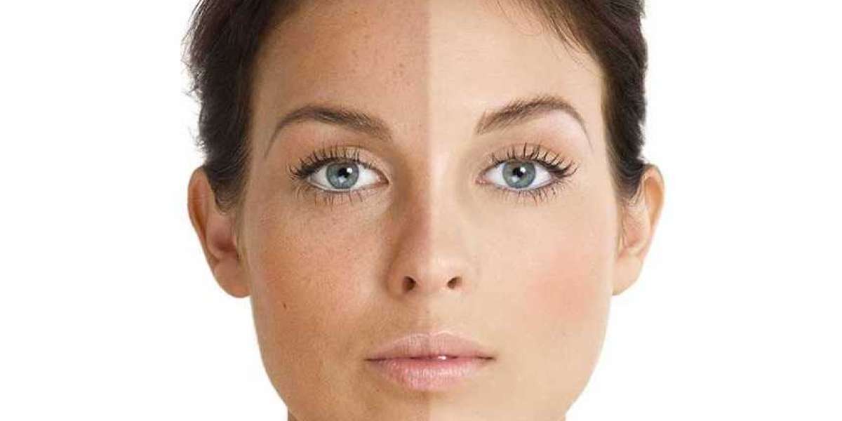 What is Photofacial Skin Rejuvenation