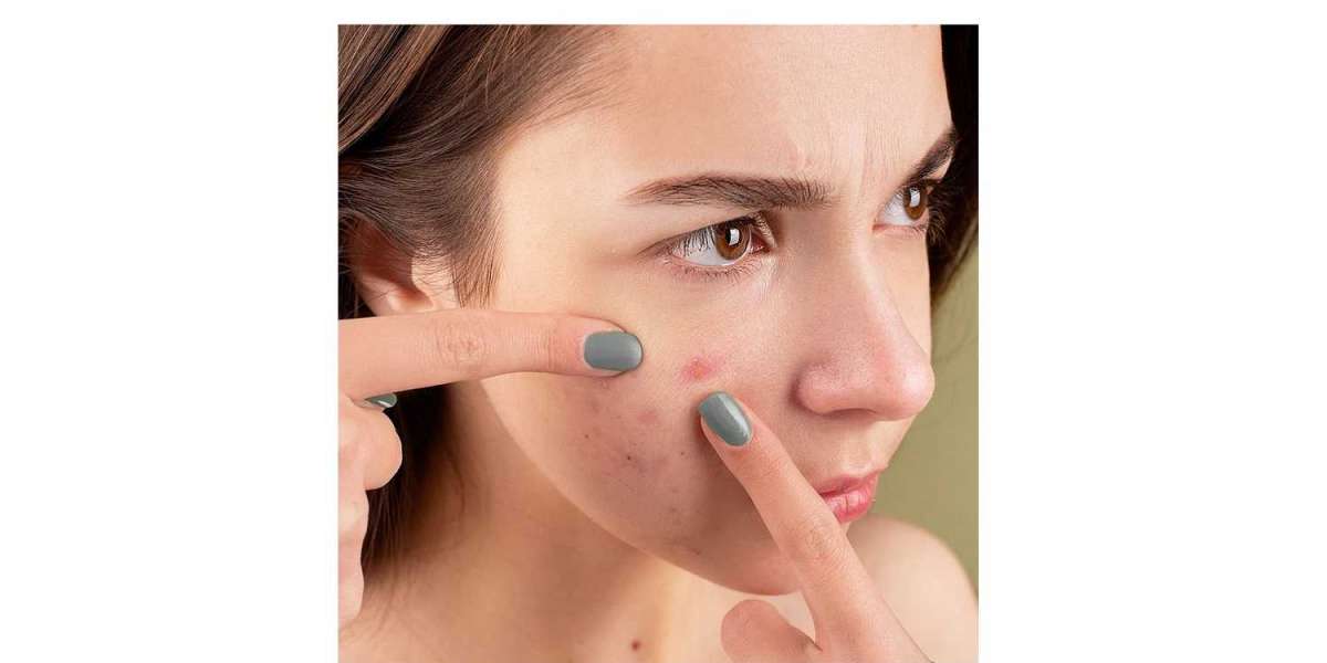 The Secrets to Effective Natural Acne Treatment