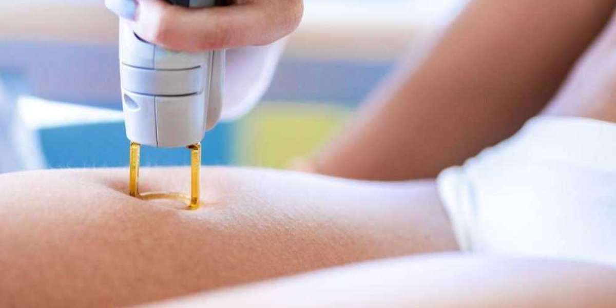 The Ultimate Guide to Laser Hair Removal: Smooth Skin Made Easy