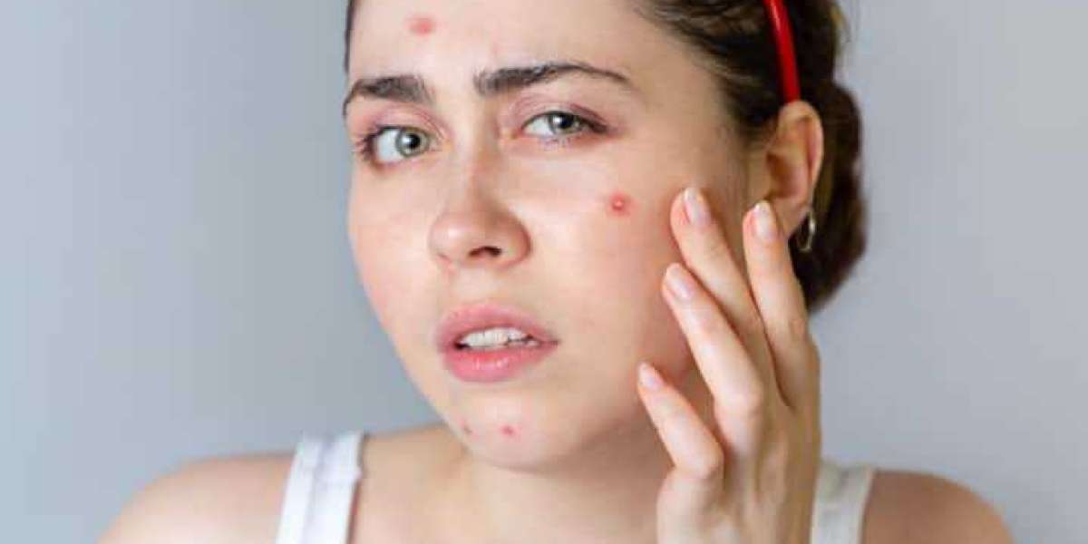 Glowing Skin Secrets: Acne Treatment in Chandigarh Unveiled