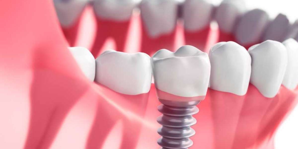 What is the cost of dental implants in Coimbatore?