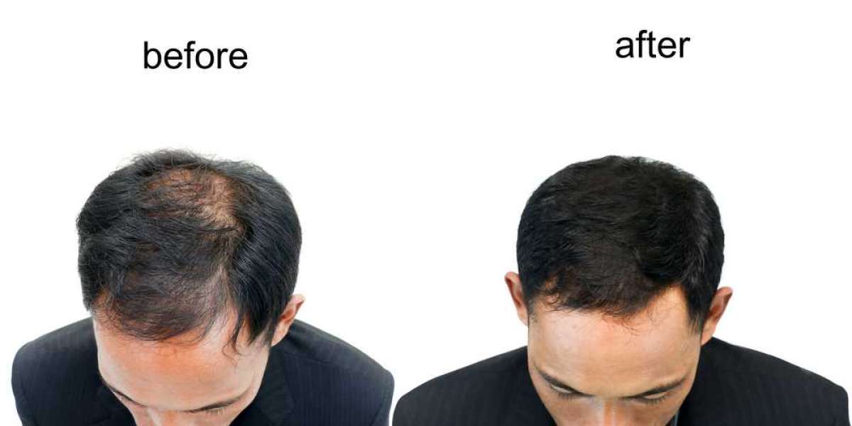 Hair Patch in Lucknow: Rediscover Your Confidence with a Natural-Looking Solution