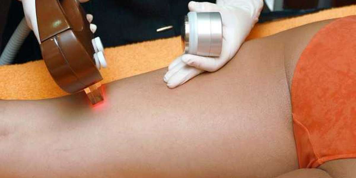 Smooth and Silky: Laser Hair Removal Service for Lasting Results