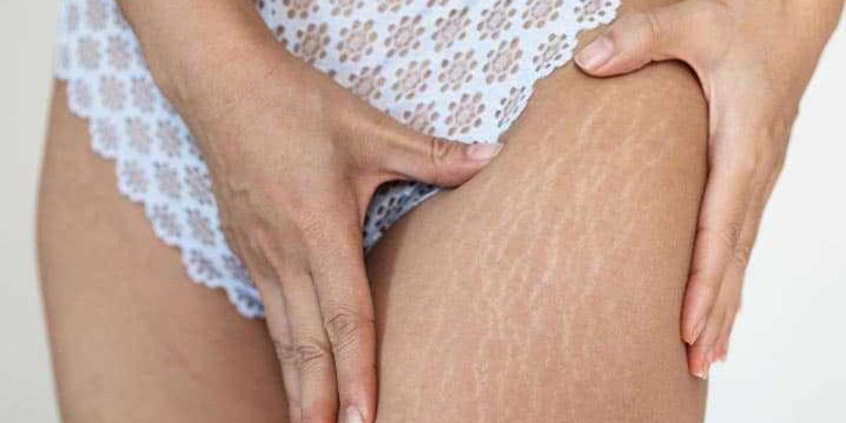 Stretch Marks: Causes and Dermatological Treatments