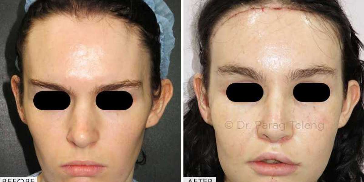 Get Best Facial Feminization Surgery Cost in USA with Dr. Parag Telang