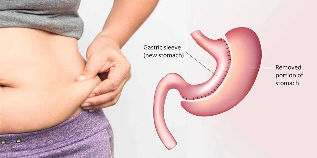gastric sleeve surgeon - Complete Weight Loss Solution