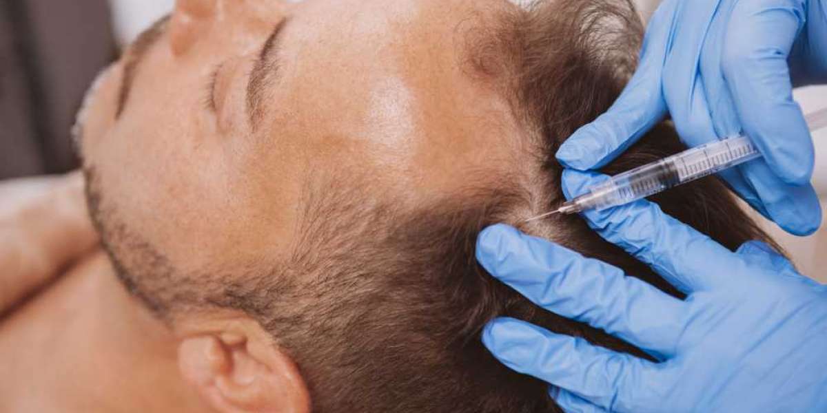 Non-Surgical Hair Transplant: Embrace a Natural Looking Mane without Surgery