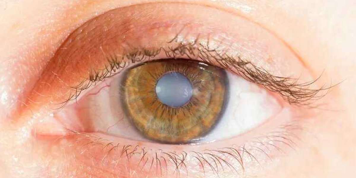 Best Hospital for Cataract Surgery