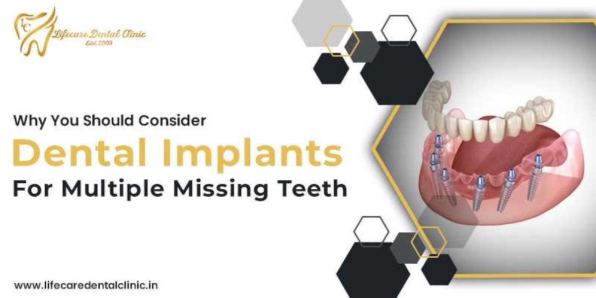 Why You Should Consider Dental Implants For Multiple Missing Teeth