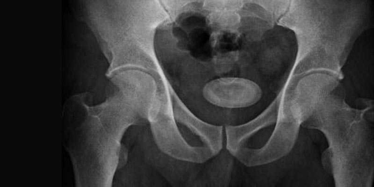 Stones in Bladder: How to Get Them Removed?