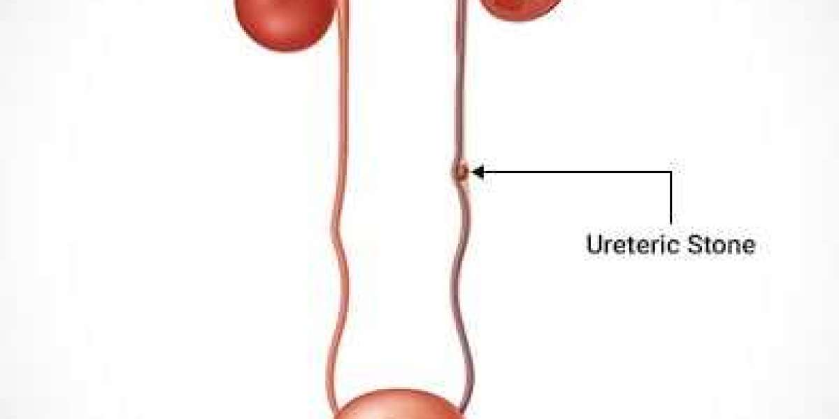 Ureteroscopy (URS): A Precise Solution for Ureteric Stones