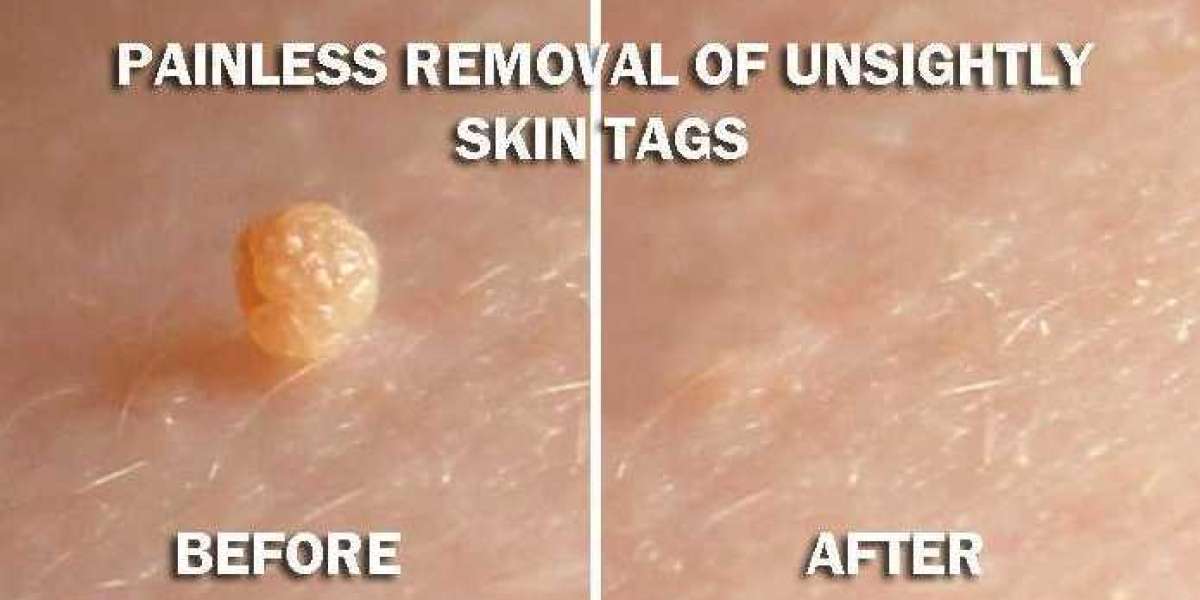 Clean As Teen Skin Tag Remover Review 2023 - Where To Buy?