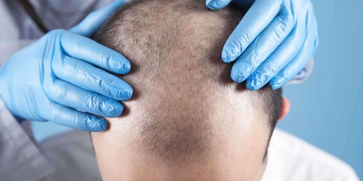 How Does Medical Tourism Impact 3000 Grafts Hair Transplant Cost In India