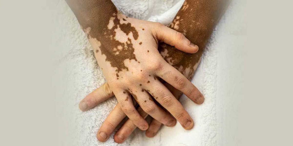 non segmental vitiligo spreading time