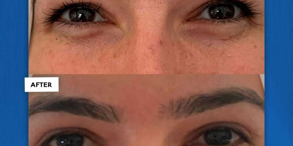 Unlocking the Beauty of Blepharoplasty: Before and After Transformations