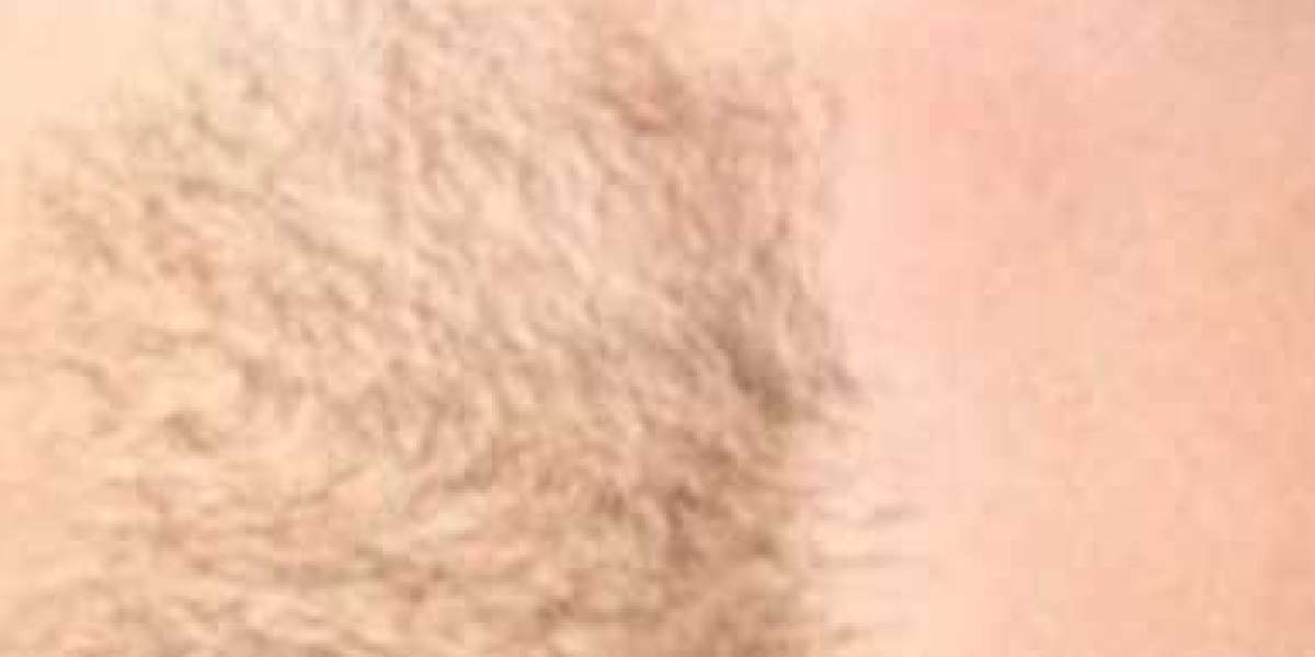 The Future of Hair Removal: Laser Technology for Long-Term Results