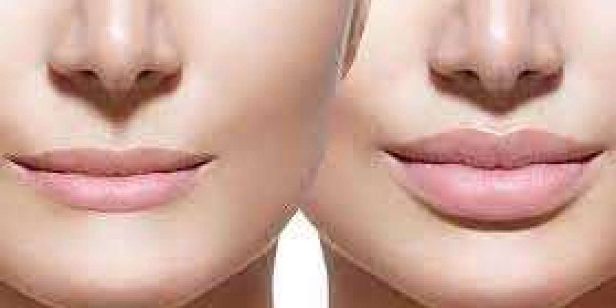 Why Many Choose Plastic Surgery in Turkey: Exploring the Allure of Cosmetic Procedures