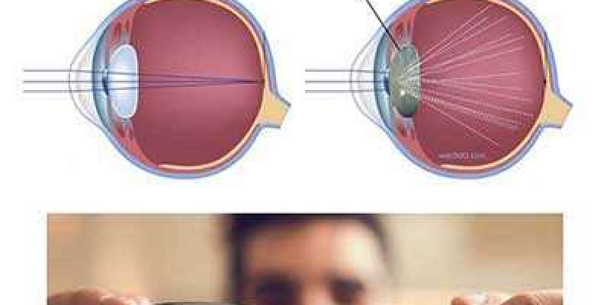 The Benefits of Consulting the Best Cataract Surgery Doctor in Kolkata