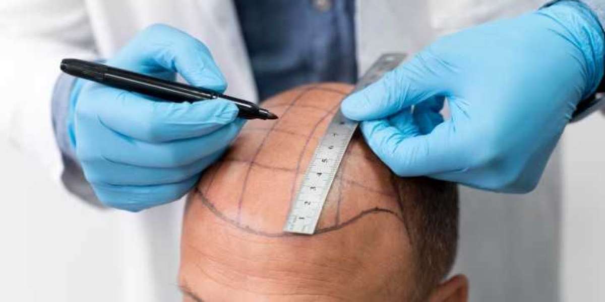 The Ultimate Guide to Hair Transplant Turkey: How to Find the Best Hair Transplant in Turkey