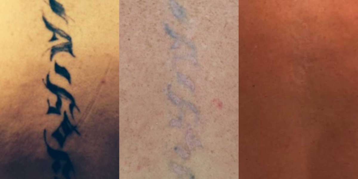 Laser tattoo Removal Brentwood, Essex & London Liverpool Street