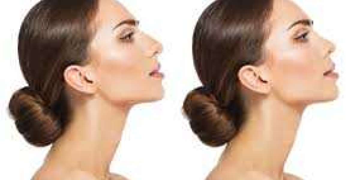 Best Ultrasonic Rhinoplasty in Dubai: A Complete Guide