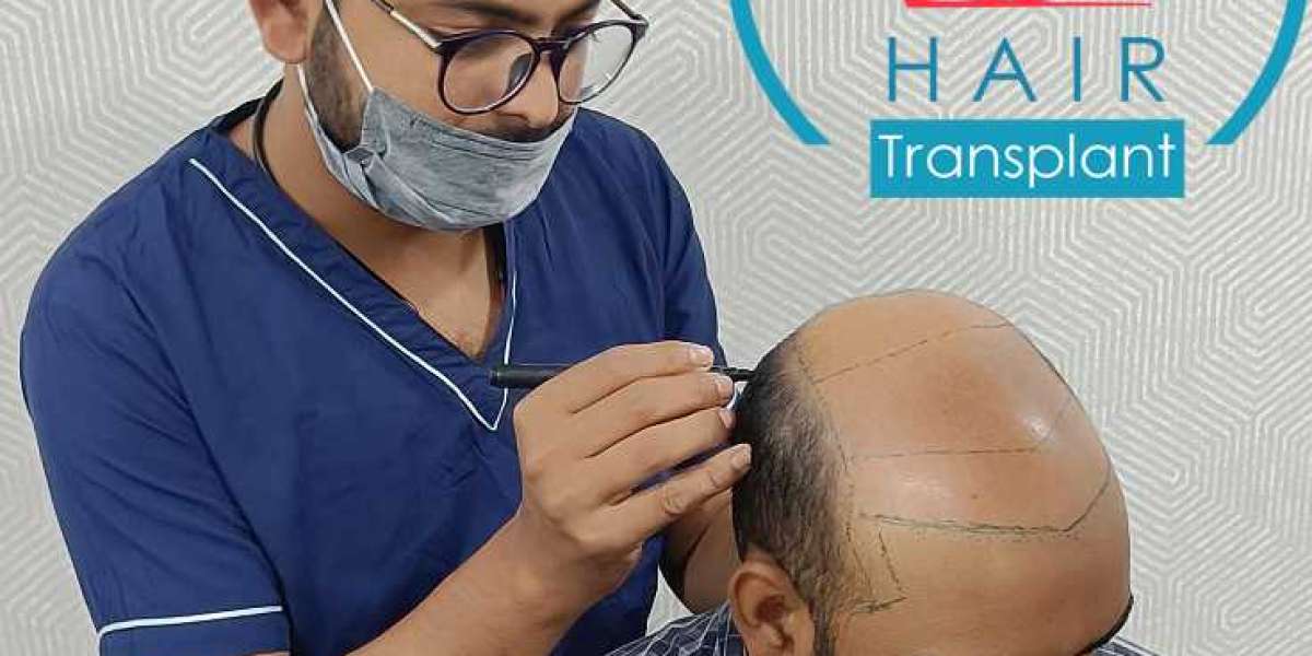Hair Transplant in Indore | Best Hair Transplant in Agra | RMD Hair Transplant 
