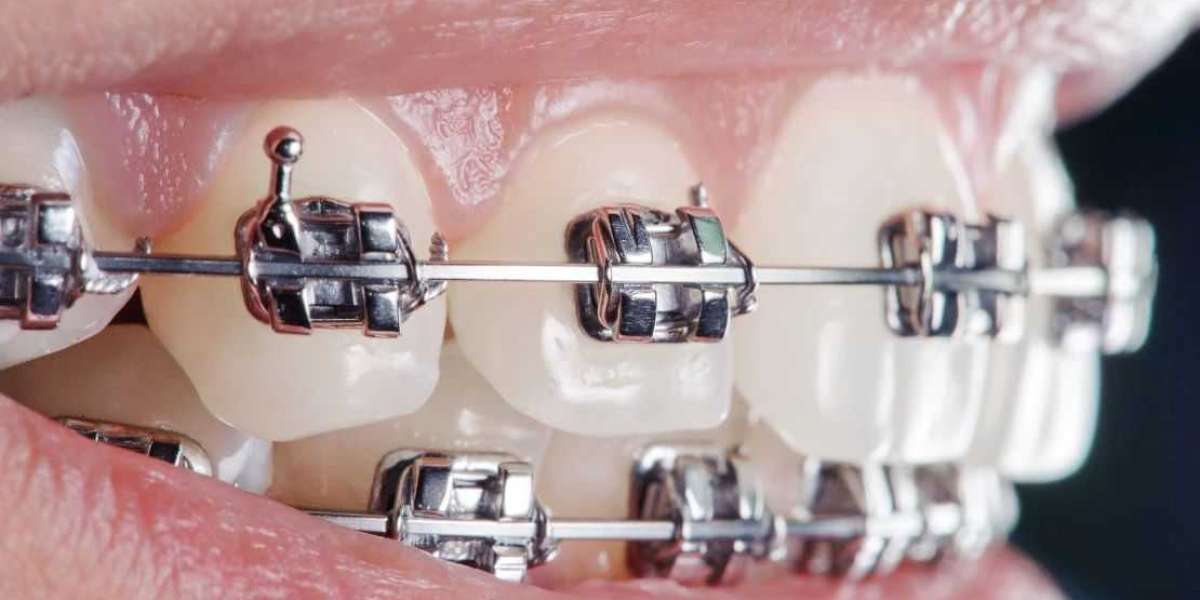 Transform Your Smile with Adult Orthodontics in Nampa, ID