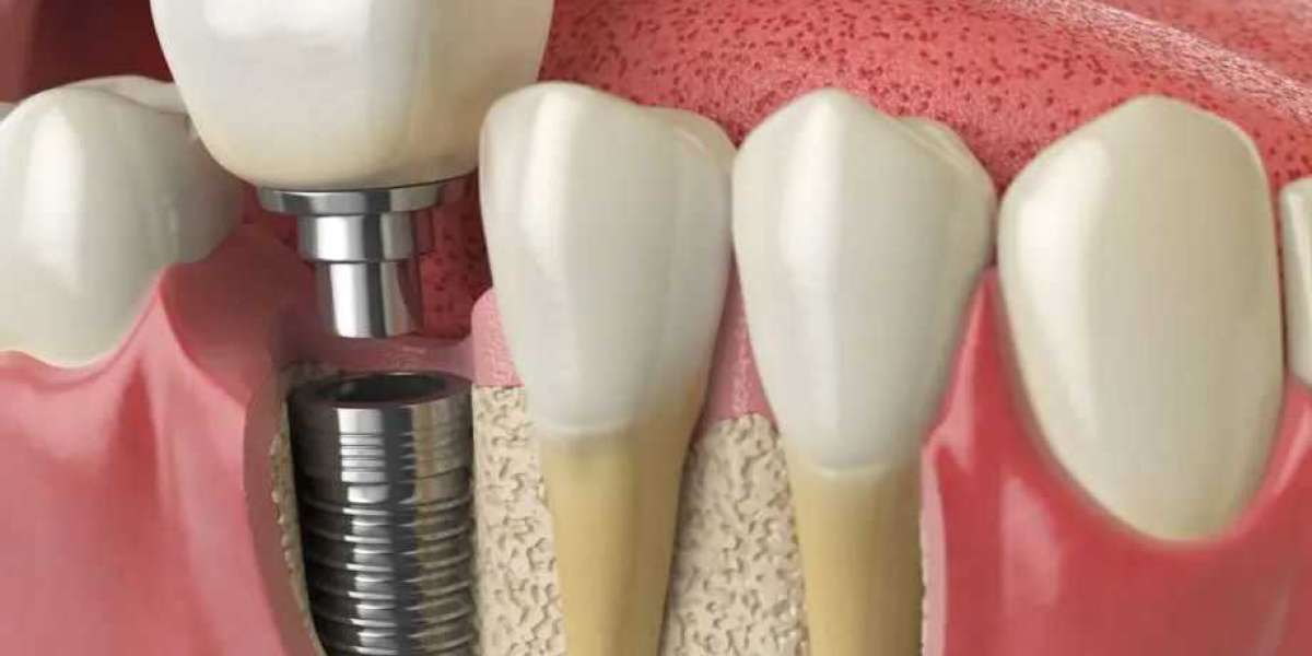 Teeth Implants: A Permanent Solution for Your Smile