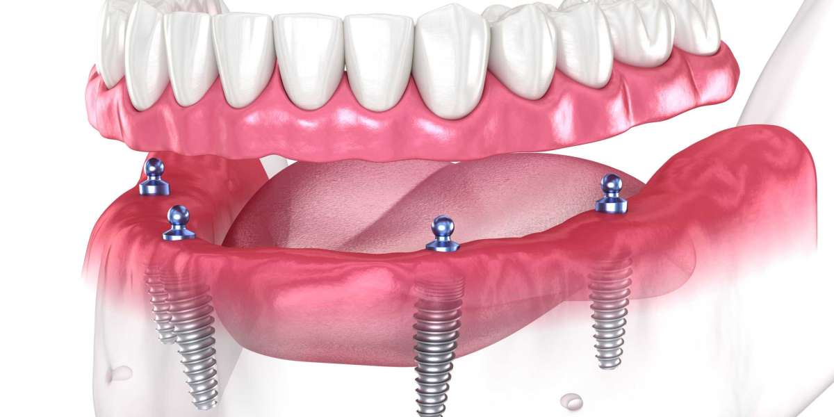 Transform Your Smile with Full Mouth Dental Implants