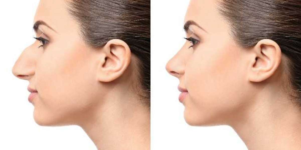 The Best Rhinoplasty Surgeons in Chicago: Tips for Choosing the Right Expert