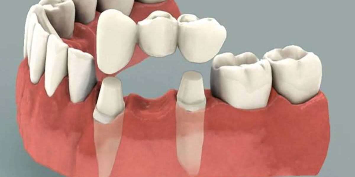 Understanding Dental Bridge Front Teeth