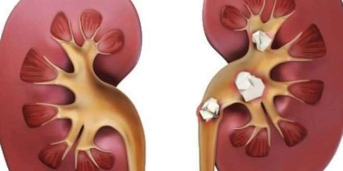 Ayurvedic Treatment For Kidney Stone: Holistic Approaches to Eliminate Kidney Stones